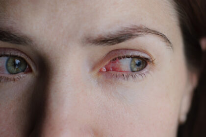 Eyebrow Dye Allergies: Symptoms, Causes & Treatments